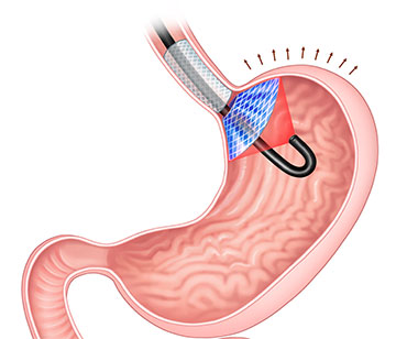 An intragastric implant