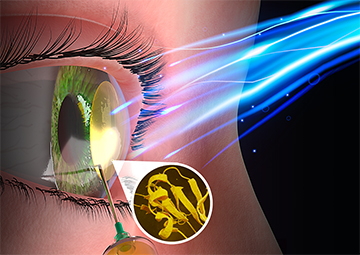 A graphic depicting a biomaterial being injected into one's cornea via a syringe and blue light hitting one's eye.